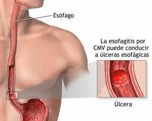 Esofagitis por CMV.jpg