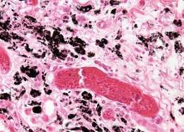 Toxoplasmosis 1.jpg