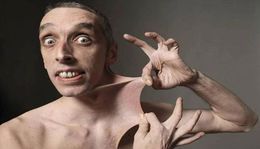 Sindrome-de-Ehlers-Danlos-tipo-11.jpg