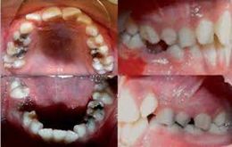 Hipofibrinogenemia.jpg