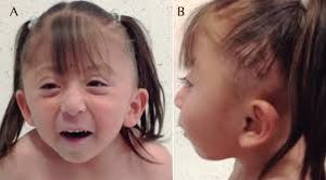 Sindrome 37q2.jpg
