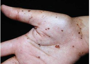 Síndrome de Lentiginosis Múltiple.jpg