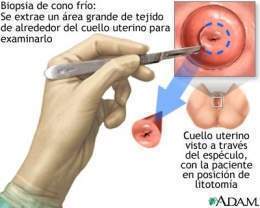 Biopsia-cuello-uter 2.jpg