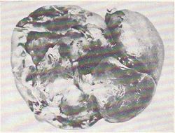 Equinococosis del bazo.jpg