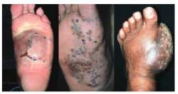 Maduromicosis-1.jpg