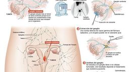Infografico ganglio centinela.jpg