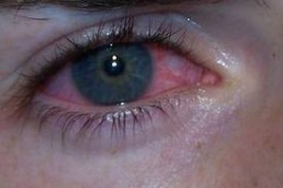Conjuntivitis catarral.jpeg