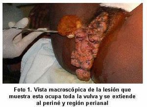 Vegetaciones venéreas en la mujer2a6f1.jpg