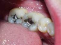 Empaste amalgama.jpg