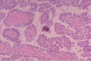 Neoplasia tir .jpg