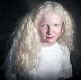 Albinismo 2.jpg