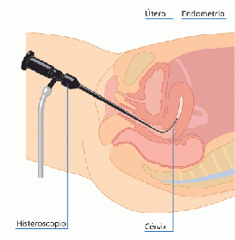 Histeroscopia 2.gif