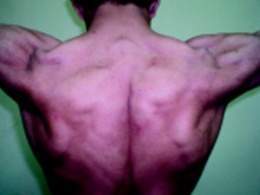 Myotonia-Congenita-Picture-300x225.jpg