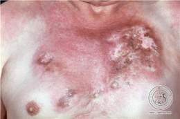 Blastomicosis norteamericana.jpg