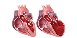 Miocardiopatia-dilatada.jpg