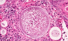 Rinosporidiosis I001.JPG