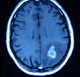 Rm-cerebral-glioma-alto-grado.jpg