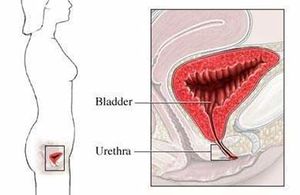SindromeUretral.jpg