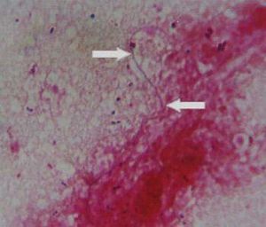 Nocardiosis pulmonar.jpg