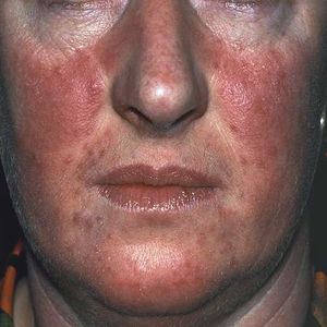 Rosacea.jpg