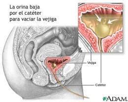Obstruc-vías-urinarias .jpg