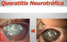 Queratitis neurotrófica.jpg