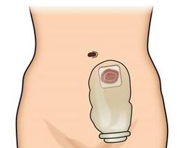 Ostomía.jpg