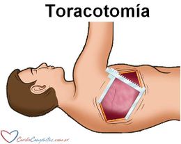 Toracotomia.jpg
