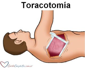 Toracotomia.jpg