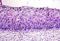 Neoplacia cervical.jpg