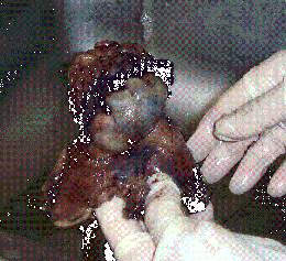 Paraganglioma estómago.GIF