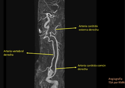 Ausencia de arteria carótida izquierda.png
