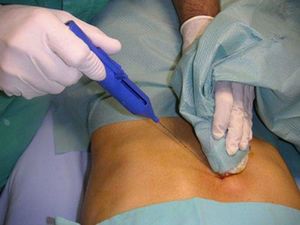 Biopsia hepatica.jpg