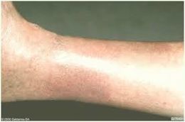 Dermatitis de Estasis.jpg