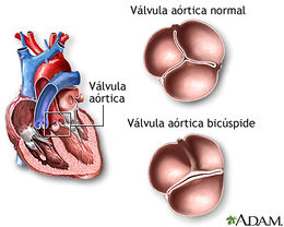 Válvula Aórtica Bicúspide.jpg