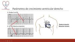 Crecimiento ventricular derecho 2.jpg