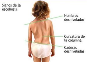 Escoleosis infantil.JPG