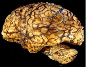 Hematoma001.JPG