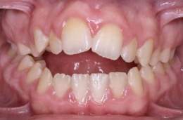 Maloclusion.jpg
