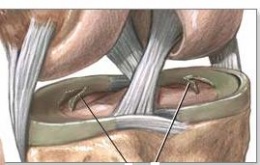 Ruptura del menisco.JPG